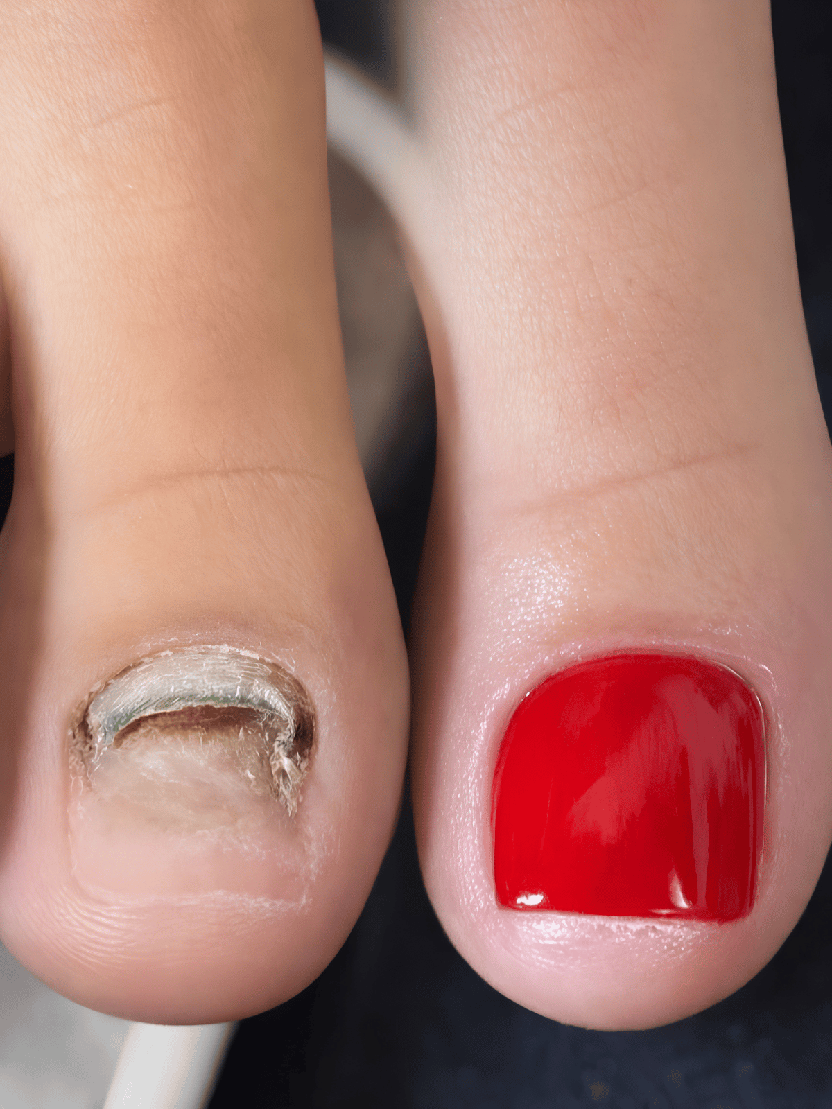ricostruzione-alluce-pedicure-modena